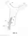 Fig. 15 - Retraction and aspiration device for treating embolism and associated systems and methods