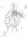 Fig. 08 - Devices, systems, and methods for auto-retroperfusion of the cerebral venous system