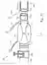 Fig. 12 - Devices, systems, and methods for auto-retroperfusion of the cerebral venous system