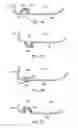 Fig. 18 - Golf club head with flexure