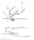 Fig. 01 - Borrelia Provocation Procedure kit