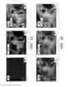 Fig. 07 - USING GALECTIN-BINDING CARBOHYDRATES AS PREDICTORS OF MELANOMA PROGRESSION AND METASTASIS