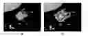 Fig. 01 - Quantitative predictors of tumor severity