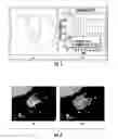 Fig. 04 - Quantitative predictors of tumor severity
