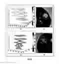 Fig. 06 - Quantitative predictors of tumor severity
