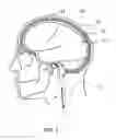 Fig. 02 - Apparatus and methods for detecting increase in intracranial pressure