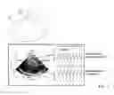 Fig. 10 - Apparatus and methods for detecting increase in intracranial pressure
