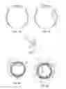 Fig. 02 - Devices and methods to provide hands free scleral depression during ophthalmic procedures