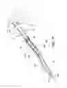 Fig. 14 - Minimally invasive surgical suturing device for papillary muscles and methods thereof