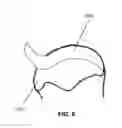 Fig. 09 - Suture for soft tissue repair