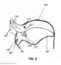 Fig. 10 - Suture for soft tissue repair