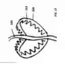 Fig. 17 - Suture for soft tissue repair
