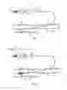 Fig. 05 - System for delivery and deployment of an occluder and method