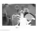 Fig. 05 - Selectively delivering particles into the distal portion of the left gastric artery