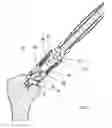 Fig. 07 - Instrument for the removal of a bone insert and corresponding method