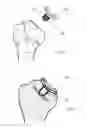 Fig. 12 - Instrument for the removal of a bone insert and corresponding method
