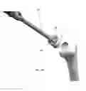 Fig. 18 - Instrument for the removal of a bone insert and corresponding method