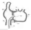 Fig. 01 - METHOD AND APPARATUS FOR ACCESSING THE LEFT ATRIAL APPENDAGE