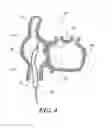 Fig. 03 - METHOD AND APPARATUS FOR ACCESSING THE LEFT ATRIAL APPENDAGE