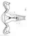 Fig. 02 - Therapeutic substance transfer catheter and method