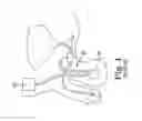 Fig. 02 - Surgical tool adapted for identifying an incision site