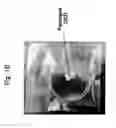 Fig. 03 - Method for use of a double-structured tissue implant for treatment of tissue defects
