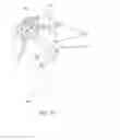 Fig. 18 - System and Method for Heart Valve Anchoring
