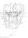 Fig. 07 - Prosthetic valve with vortice-inducing baffle