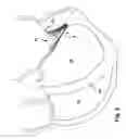 Fig. 06 - Device, system, and method for treating a regurgitant heart valve