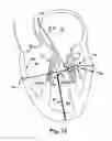 Fig. 13 - Device, system, and method for treating a regurgitant heart valve