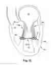 Fig. 14 - Device, system, and method for treating a regurgitant heart valve