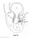 Fig. 15 - Device, system, and method for treating a regurgitant heart valve