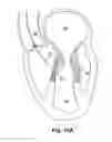 Fig. 16 - Device, system, and method for treating a regurgitant heart valve