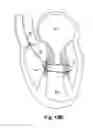 Fig. 17 - Device, system, and method for treating a regurgitant heart valve