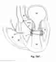 Fig. 18 - Device, system, and method for treating a regurgitant heart valve