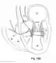 Fig. 19 - Device, system, and method for treating a regurgitant heart valve