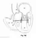 Fig. 20 - Device, system, and method for treating a regurgitant heart valve