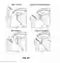 Fig. 08 - Joint replacement or joint resurfacing devices, systems and methods
