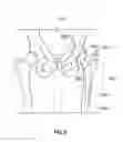 Fig. 14 - Joint replacement or joint resurfacing devices, systems and methods