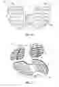 Fig. 22 - TIBIAL PROSTHESIS SYSTEMS, KITS, AND METHODS