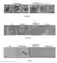 Fig. 38 - Methods of treating, preventing and diagnosing leukemia and other blood diseases and disorders