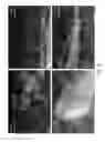 Fig. 55 - Transcription factor-based generation of pacemaker cells and methods of using same