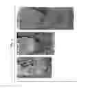 Fig. 02 - Methods and Related Kits for Treating and Regenerating Tooth Pulp and Periapical Tissues in a Mammal