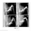 Fig. 13 - Methods and compositions for bone formation