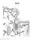 Fig. 11 - Compositions and methods for treating pathological calcification and ossification