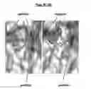 Fig. 18 - Compositions and methods for treating pathological calcification and ossification