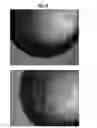 Fig. 23 - Compositions and methods for treating pathological calcification and ossification