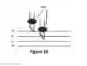 Fig. 30 - Methods for local drug delivery by microinjection array
