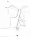 Fig. 02 - AXIALLY SPLIT FOAM PERITONEAL DIALYSIS CATHETER DESIGN WITH FUNCTIONAL COATINGS