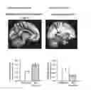 Fig. 01 - WHITE MATTER DIFFUSION TENSOR IMAGING TEST TO PREDICT TREATMENT OUTCOMES IN MEDICAL TREATMENT